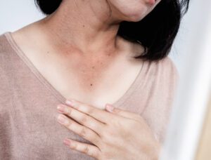 Woman with sunburned neck and chest