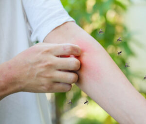 Man scratching arm red with mosquito bites.